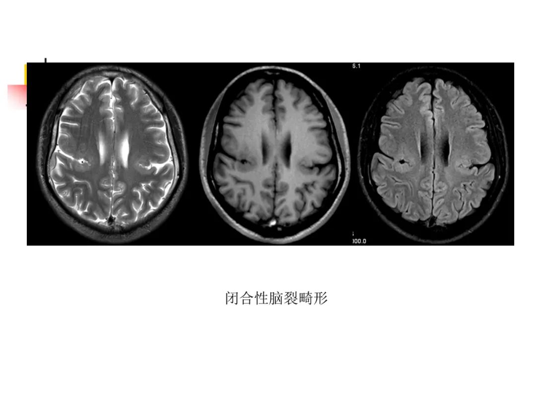 影像PPT - 【PPT】先天畸形、变性及椎管疾病-24