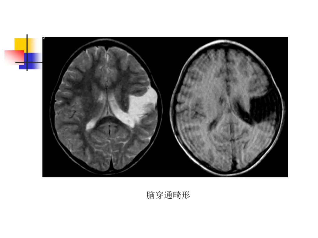 影像PPT - 【PPT】先天畸形、变性及椎管疾病-25
