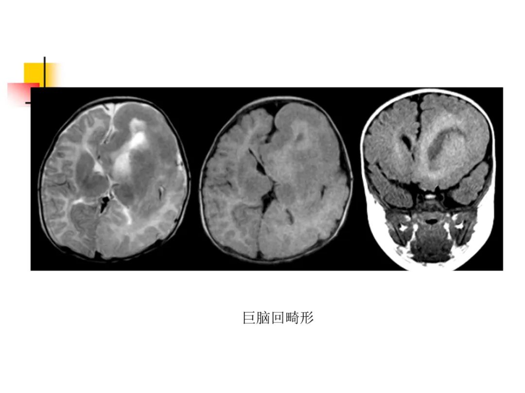 影像PPT - 【PPT】先天畸形、变性及椎管疾病-27