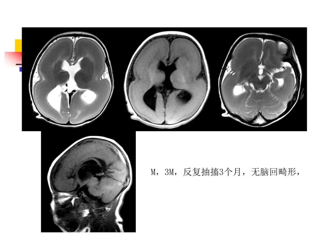 影像PPT - 【PPT】先天畸形、变性及椎管疾病-28