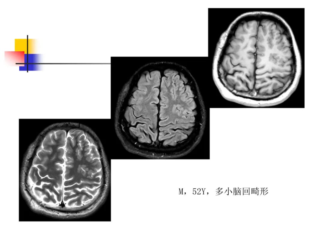 影像PPT - 【PPT】先天畸形、变性及椎管疾病-30