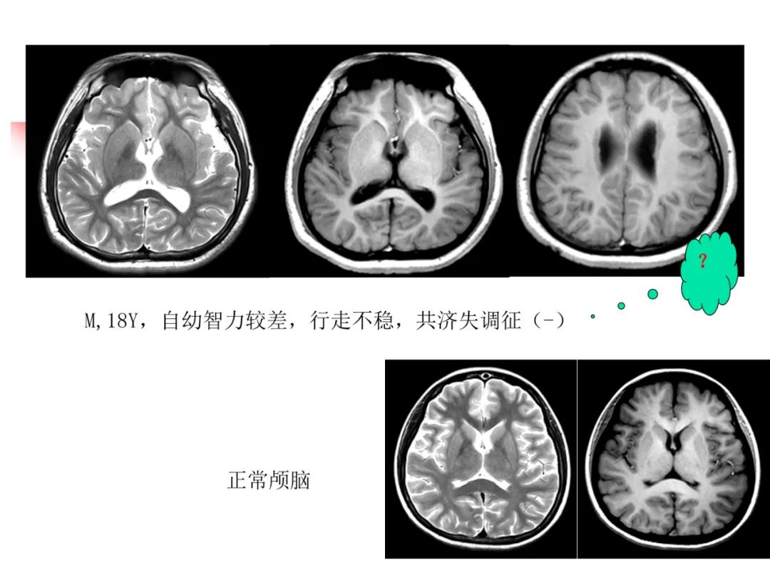 影像PPT - 【PPT】先天畸形、变性及椎管疾病-32