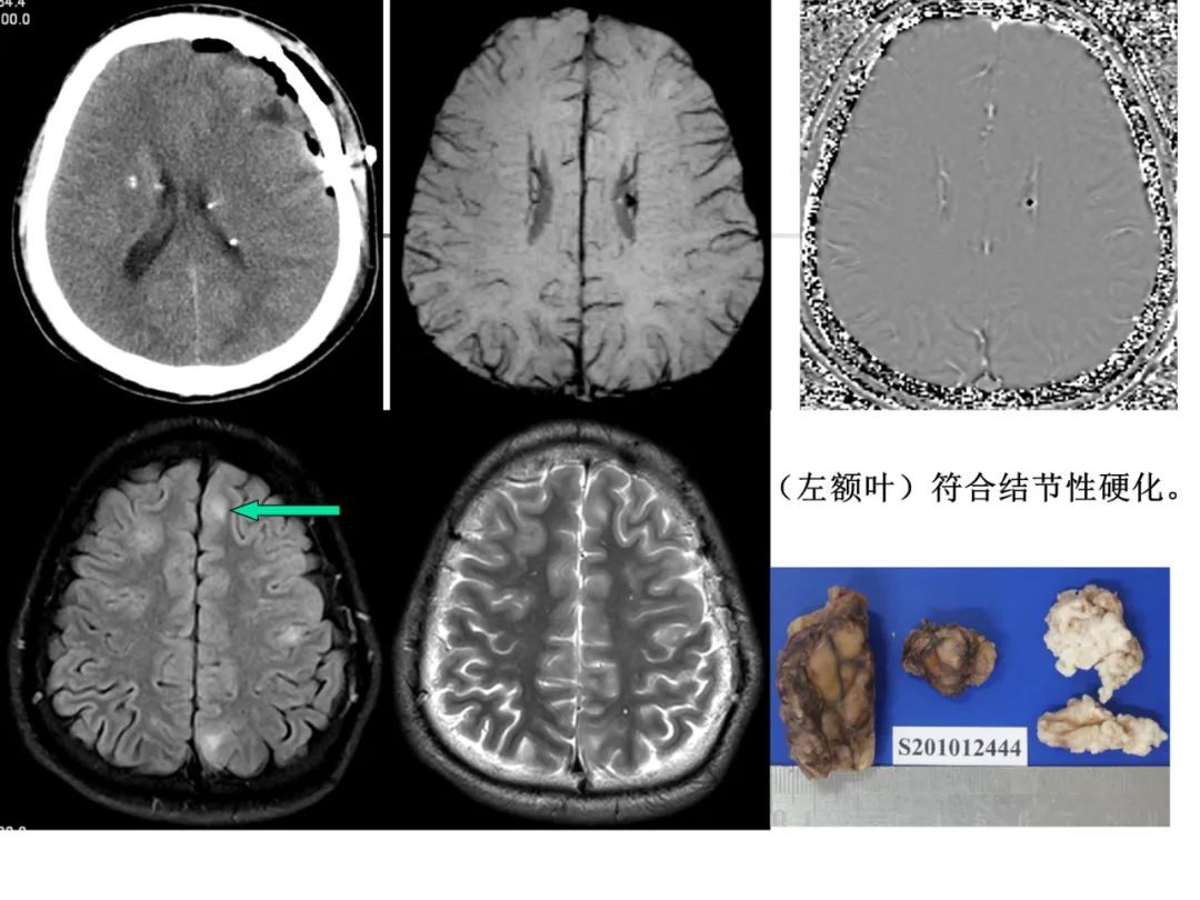 影像PPT - 【PPT】先天畸形、变性及椎管疾病-35