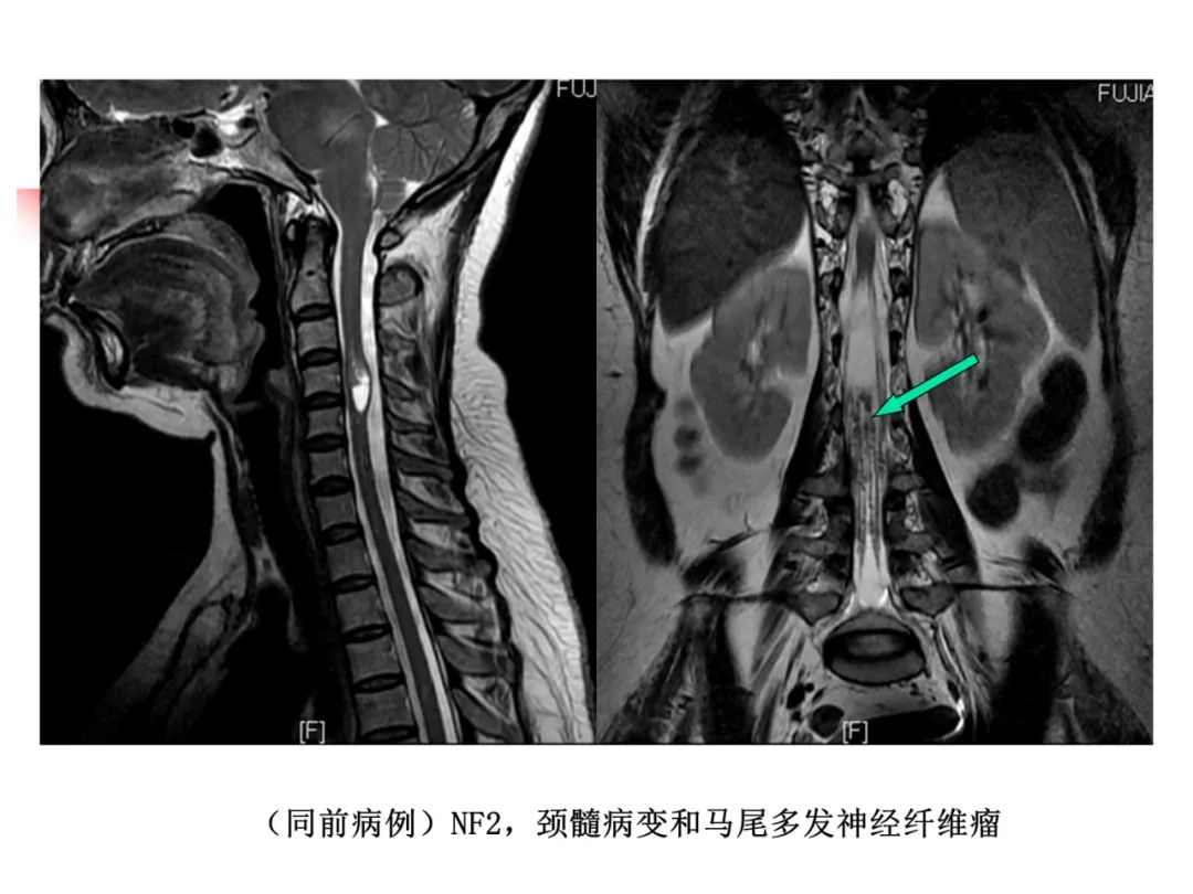 影像PPT - 【PPT】先天畸形、变性及椎管疾病-49