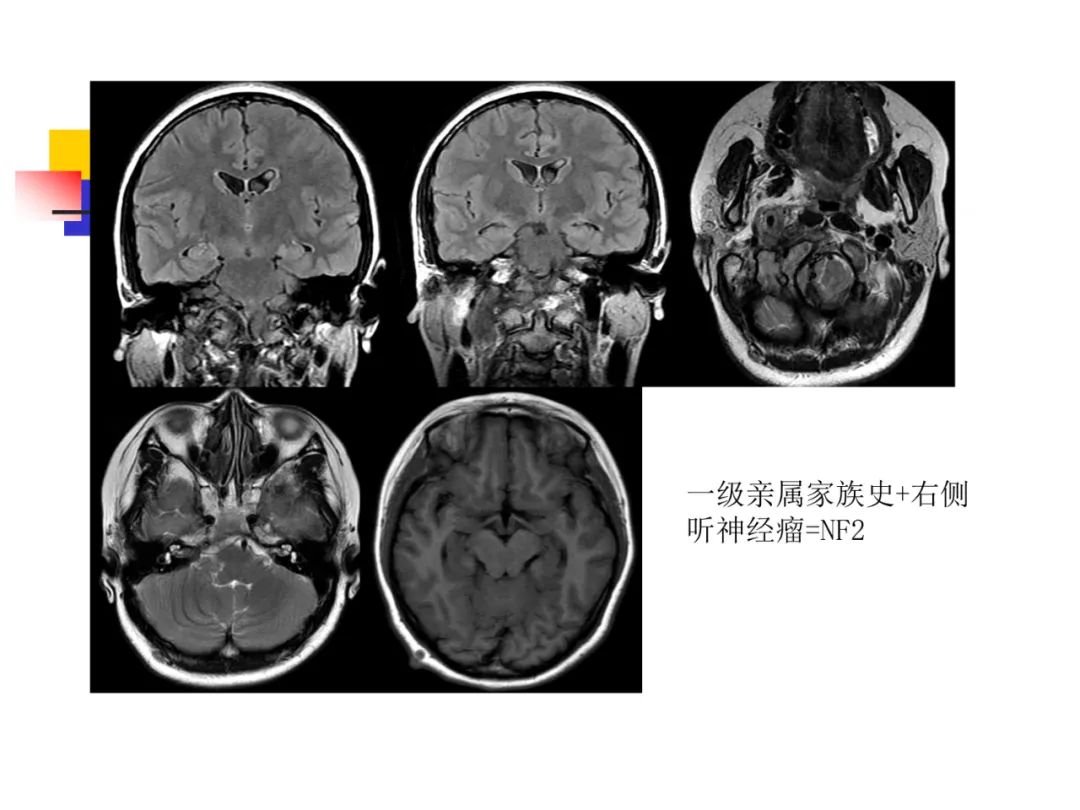 影像PPT - 【PPT】先天畸形、变性及椎管疾病-51