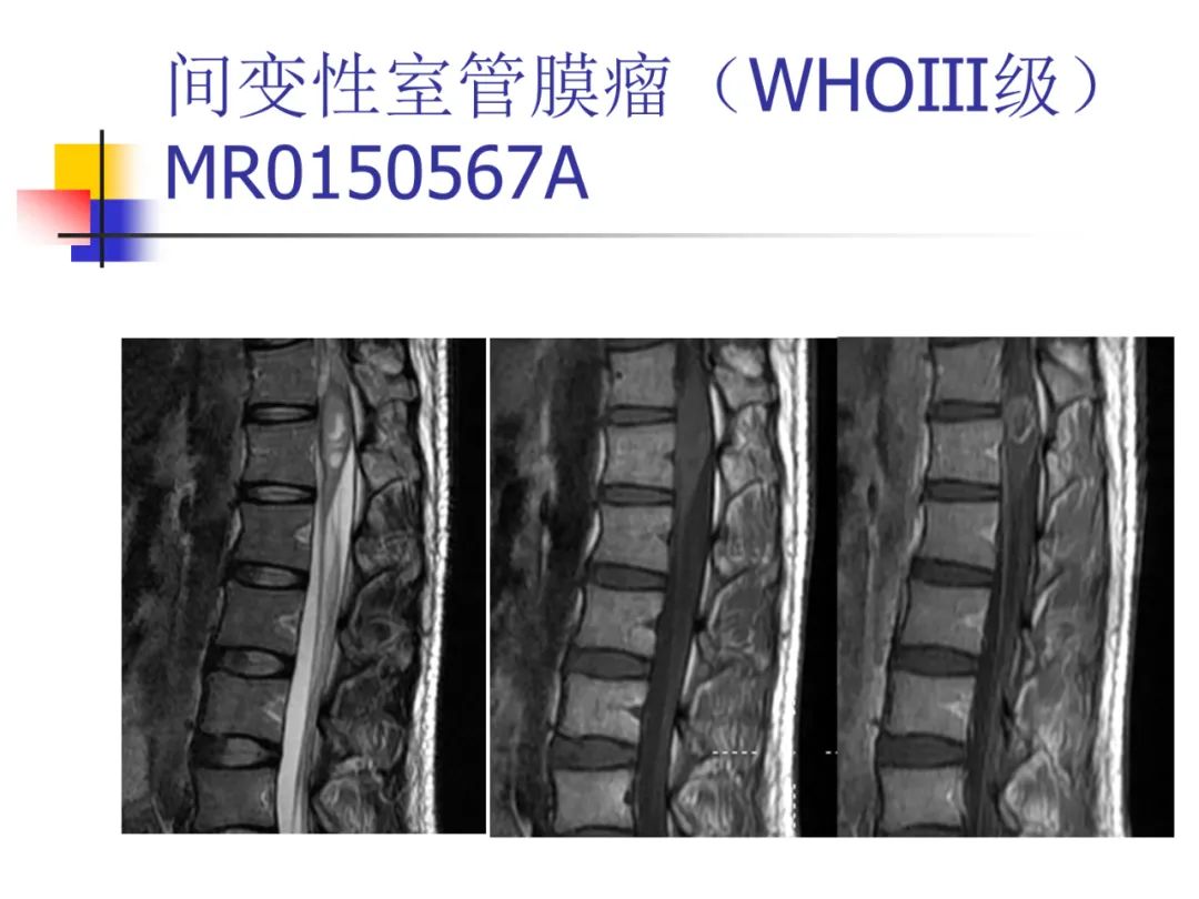 影像PPT - 【PPT】先天畸形、变性及椎管疾病-85