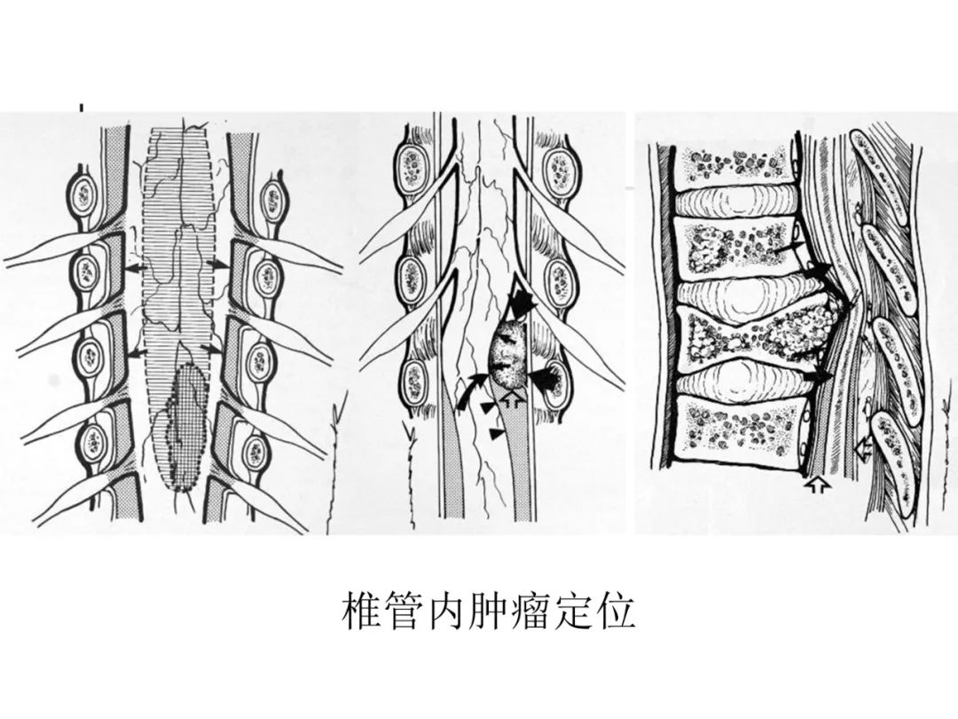 影像PPT - 【PPT】先天畸形、变性及椎管疾病-81