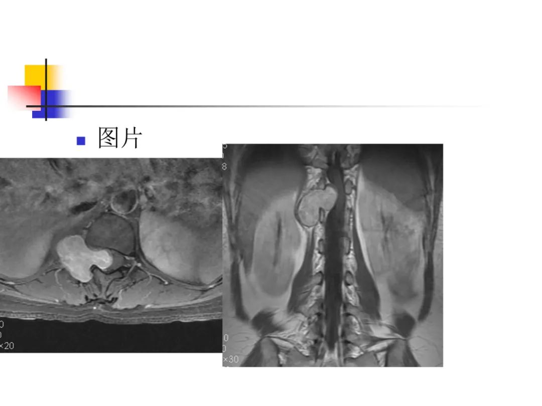影像PPT - 【PPT】先天畸形、变性及椎管疾病-91