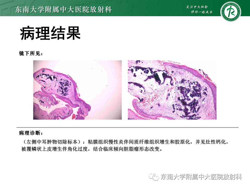 影像PPT - 【PPT】中耳胆脂瘤-3 影像PPT - 【PPT】中耳胆脂瘤-3