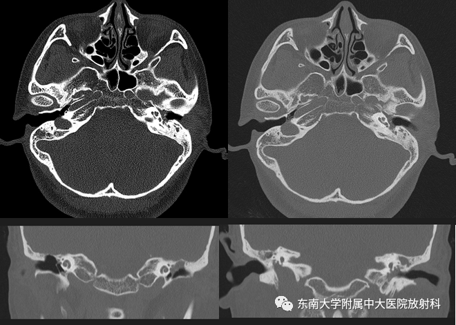 影像PPT - 【PPT】中耳胆脂瘤-1 影像PPT - 【PPT】中耳胆脂瘤-1