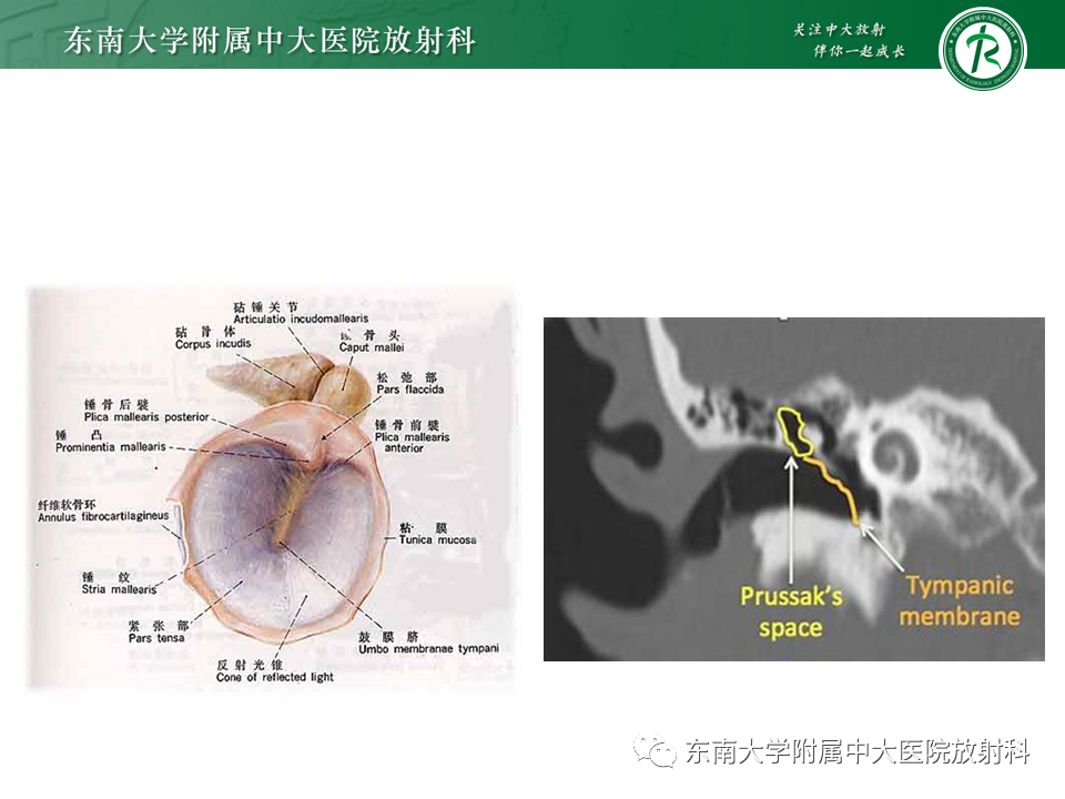 影像PPT - 【PPT】中耳胆脂瘤-12 影像PPT - 【PPT】中耳胆脂瘤-12