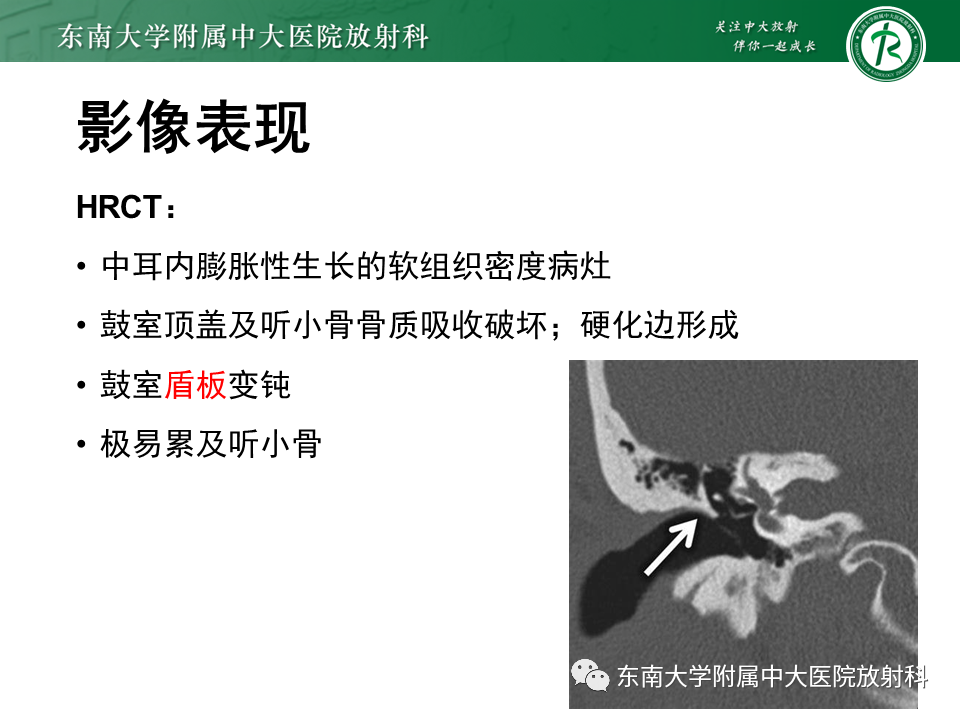 影像PPT - 【PPT】中耳胆脂瘤-17 影像PPT - 【PPT】中耳胆脂瘤-17