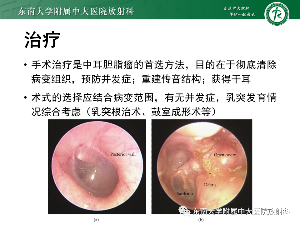 影像PPT - 【PPT】中耳胆脂瘤-19 影像PPT - 【PPT】中耳胆脂瘤-19