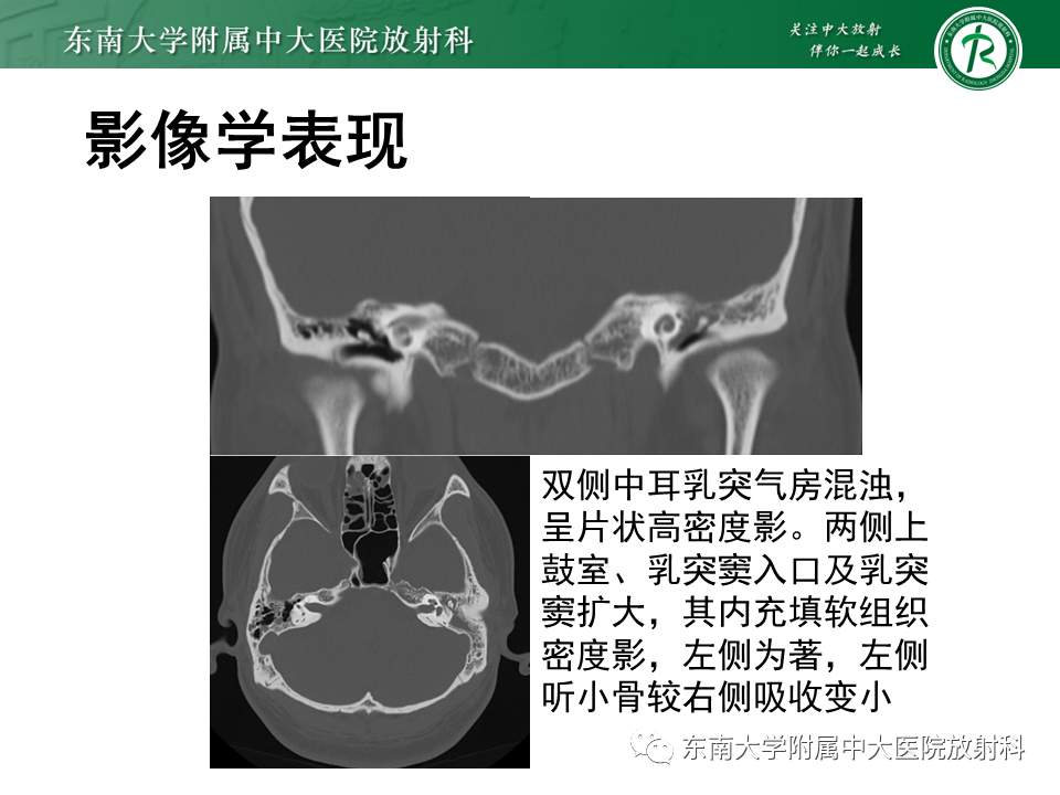 影像PPT - 【PPT】中耳胆脂瘤-24 影像PPT - 【PPT】中耳胆脂瘤-24