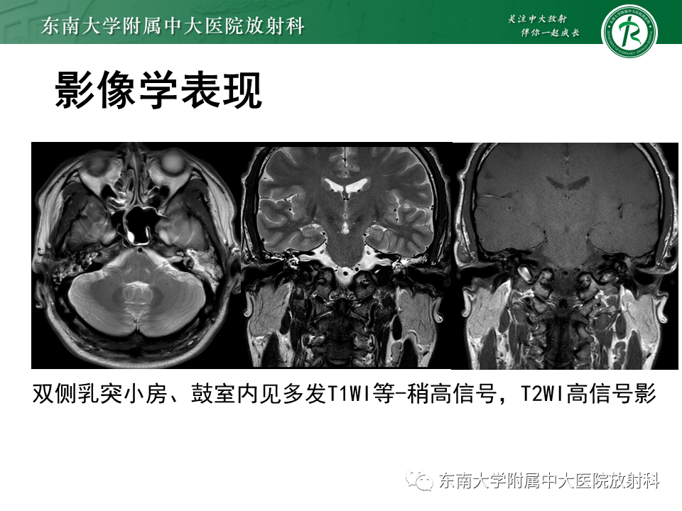 影像PPT - 【PPT】中耳胆脂瘤-25 影像PPT - 【PPT】中耳胆脂瘤-25