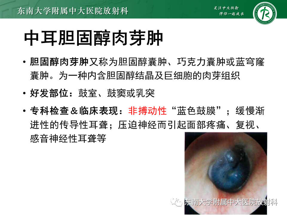影像PPT - 【PPT】中耳胆脂瘤-26 影像PPT - 【PPT】中耳胆脂瘤-26