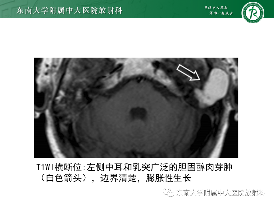 影像PPT - 【PPT】中耳胆脂瘤-28 影像PPT - 【PPT】中耳胆脂瘤-28