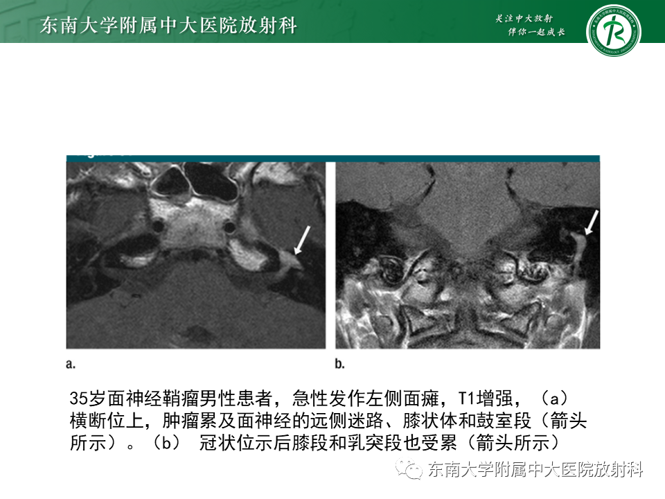 影像PPT - 【PPT】中耳胆脂瘤-31 影像PPT - 【PPT】中耳胆脂瘤-31