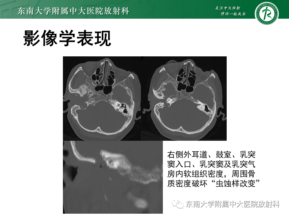 影像PPT - 【PPT】中耳胆脂瘤-35 影像PPT - 【PPT】中耳胆脂瘤-35