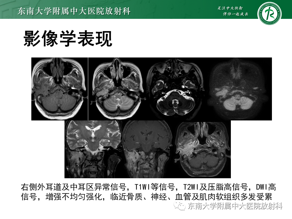 影像PPT - 【PPT】中耳胆脂瘤-36 影像PPT - 【PPT】中耳胆脂瘤-36