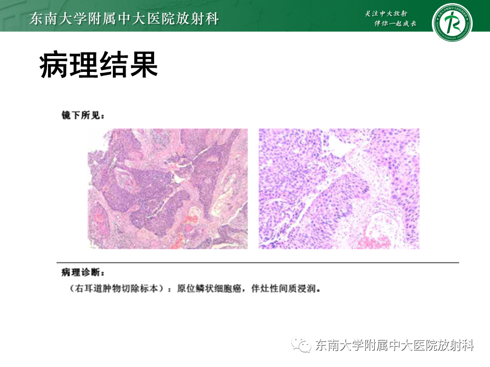 影像PPT - 【PPT】中耳胆脂瘤-40 影像PPT - 【PPT】中耳胆脂瘤-40
