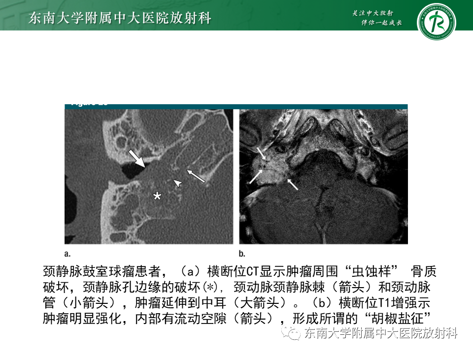 影像PPT - 【PPT】中耳胆脂瘤-39 影像PPT - 【PPT】中耳胆脂瘤-39