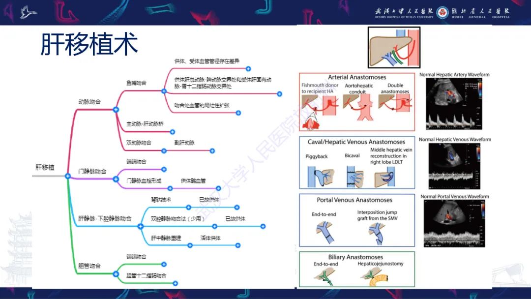 影像PPT - 【PPT】肝移植术后并发症影像诊断-5