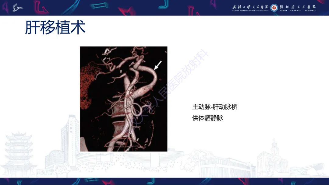 影像PPT - 【PPT】肝移植术后并发症影像诊断-6