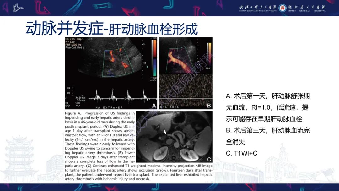 影像PPT - 【PPT】肝移植术后并发症影像诊断-10