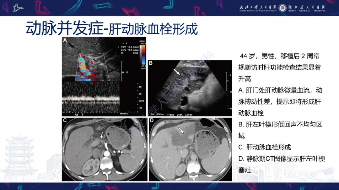 影像PPT - 【PPT】肝移植术后并发症影像诊断-11
