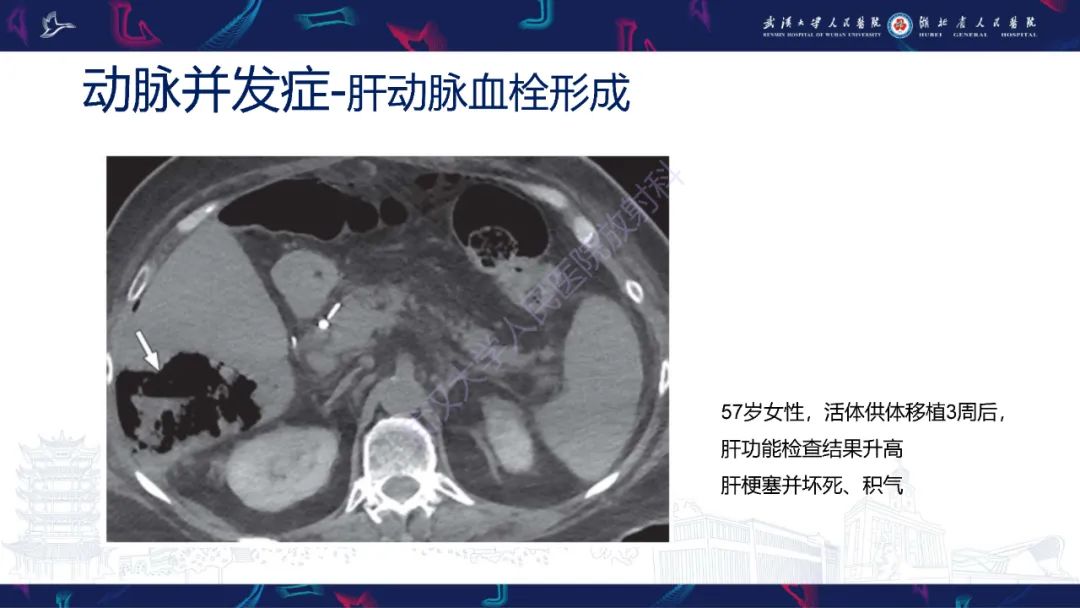影像PPT - 【PPT】肝移植术后并发症影像诊断-12