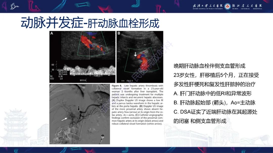 影像PPT - 【PPT】肝移植术后并发症影像诊断-13