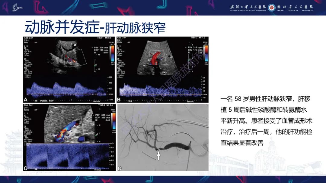 影像PPT - 【PPT】肝移植术后并发症影像诊断-15