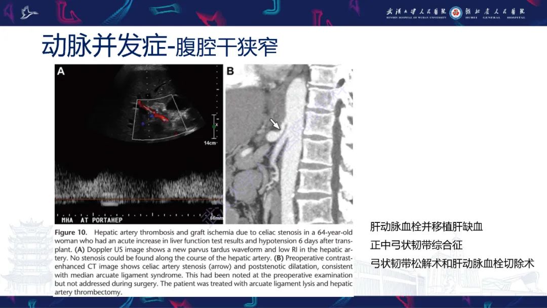 影像PPT - 【PPT】肝移植术后并发症影像诊断-17