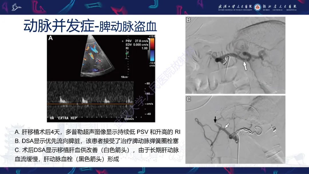 影像PPT - 【PPT】肝移植术后并发症影像诊断-20