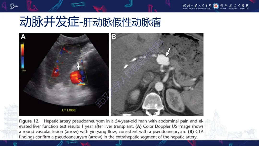 影像PPT - 【PPT】肝移植术后并发症影像诊断-22