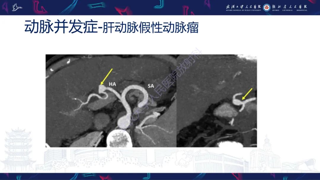 影像PPT - 【PPT】肝移植术后并发症影像诊断-23