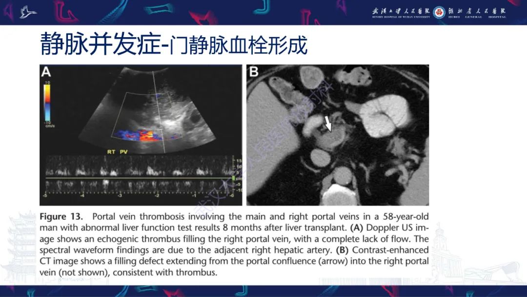 影像PPT - 【PPT】肝移植术后并发症影像诊断-25
