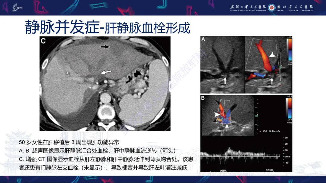 影像PPT - 【PPT】肝移植术后并发症影像诊断-26