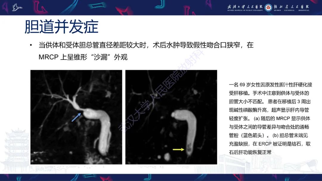 影像PPT - 【PPT】肝移植术后并发症影像诊断-28
