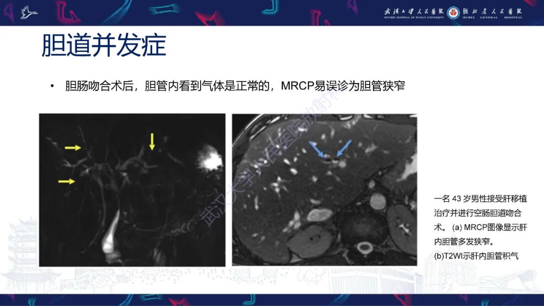 影像PPT - 【PPT】肝移植术后并发症影像诊断-29