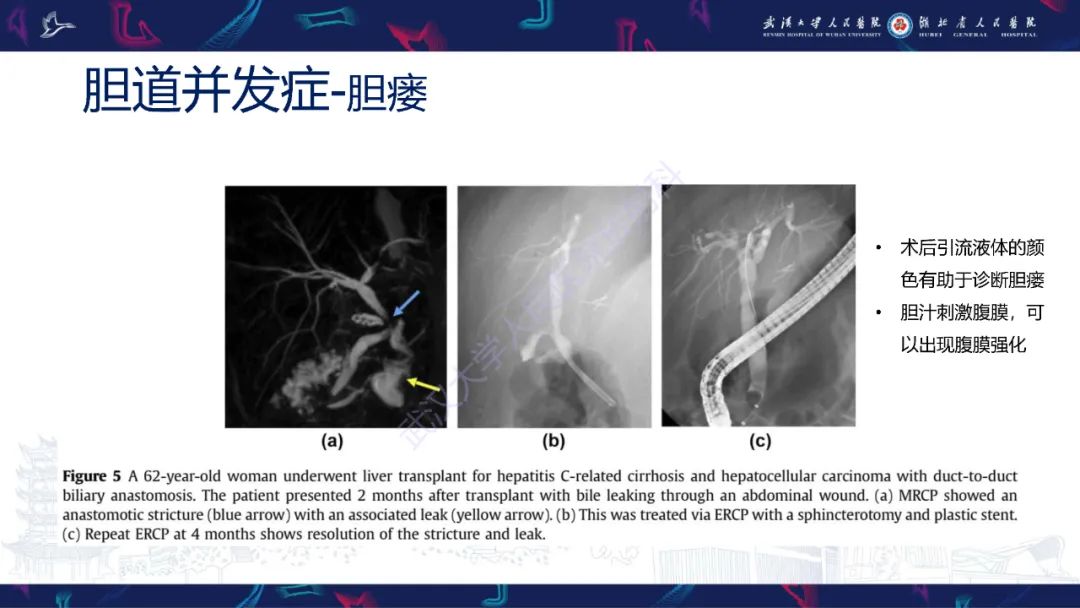 影像PPT - 【PPT】肝移植术后并发症影像诊断-30