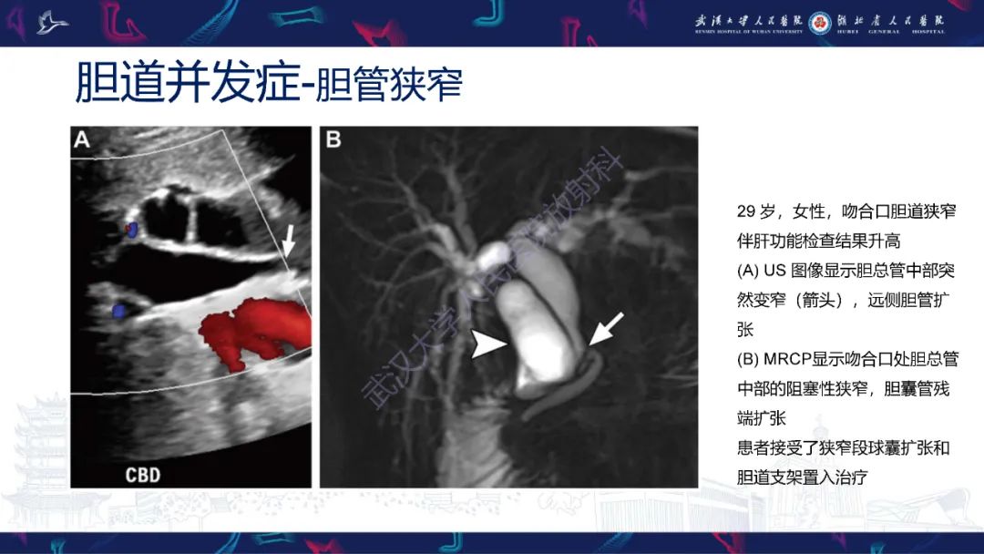 影像PPT - 【PPT】肝移植术后并发症影像诊断-31