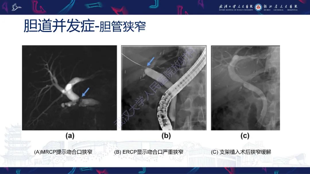 影像PPT - 【PPT】肝移植术后并发症影像诊断-32