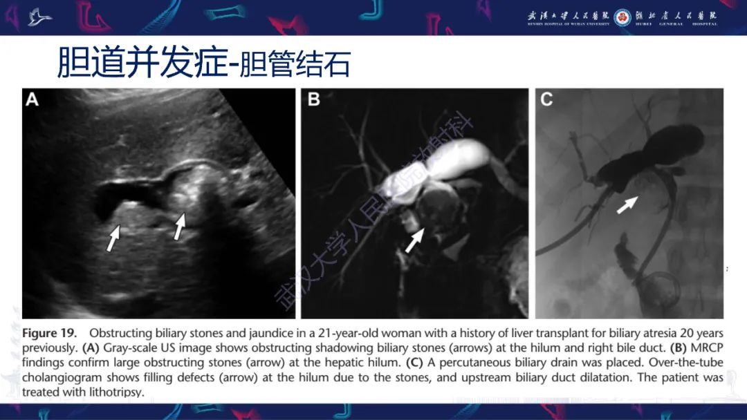 影像PPT - 【PPT】肝移植术后并发症影像诊断-33