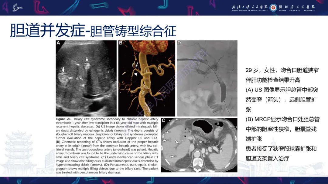 影像PPT - 【PPT】肝移植术后并发症影像诊断-34