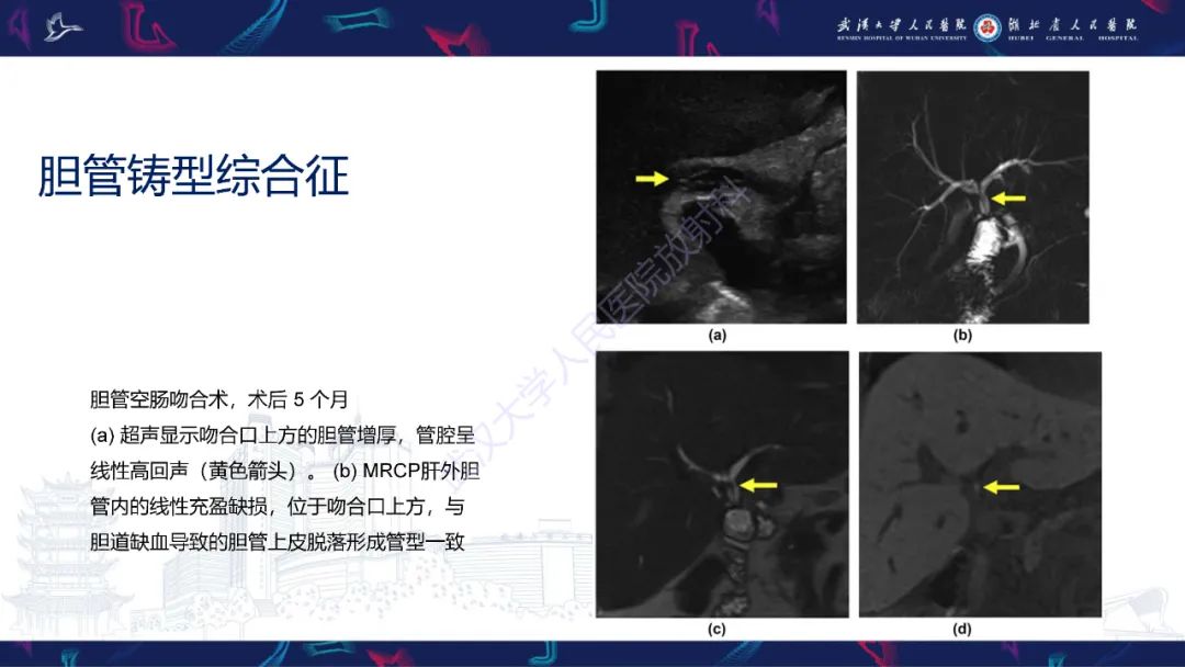 影像PPT - 【PPT】肝移植术后并发症影像诊断-35