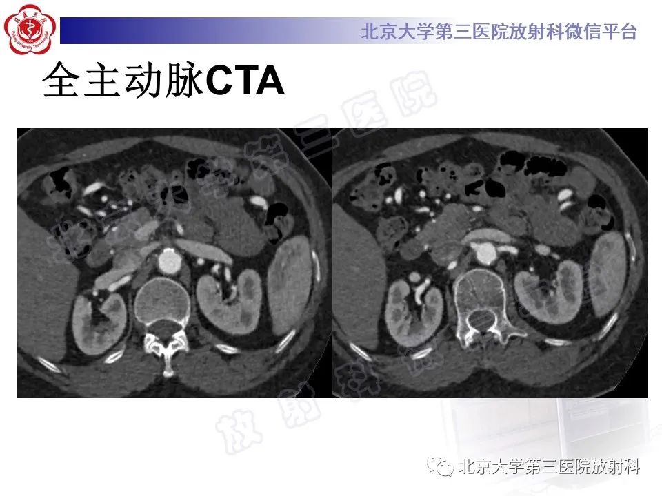 影像PPT - 【PPT】大动脉炎-3