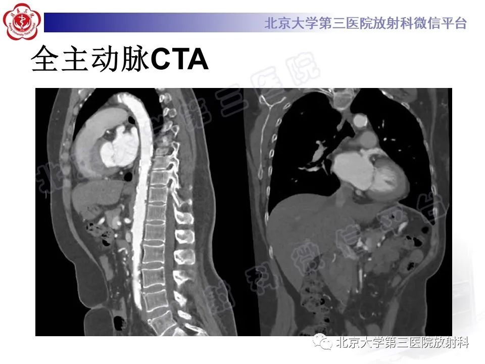 影像PPT - 【PPT】大动脉炎-4