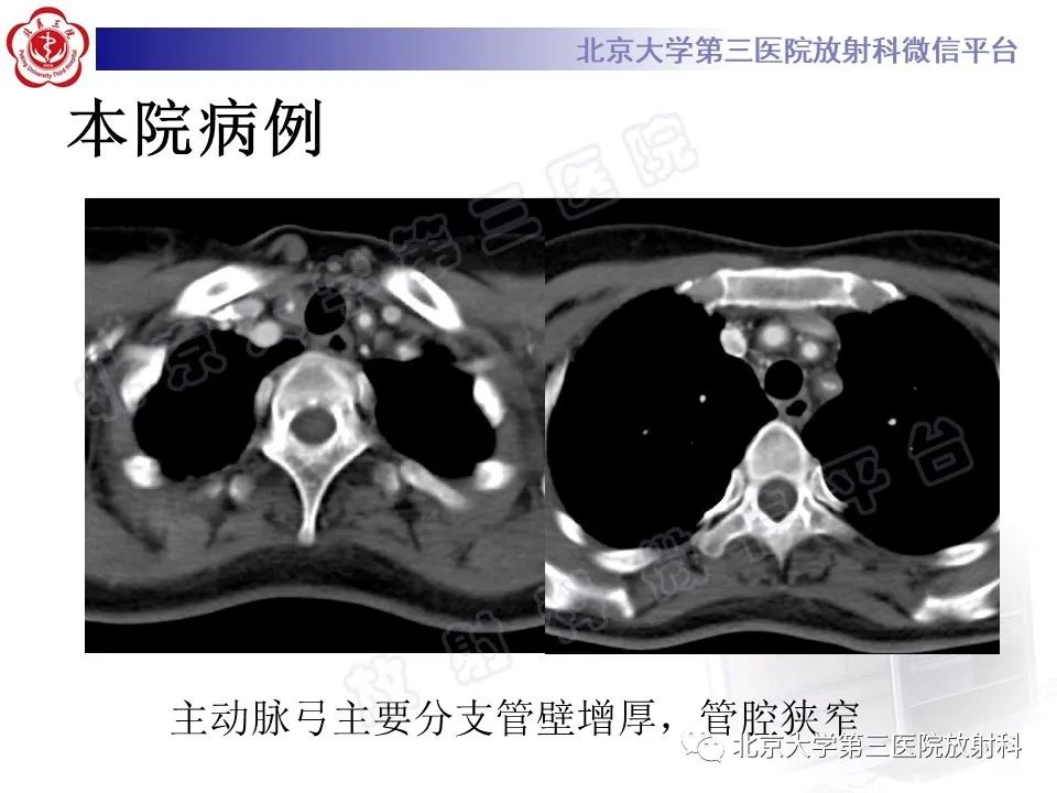 影像PPT - 【PPT】大动脉炎-21